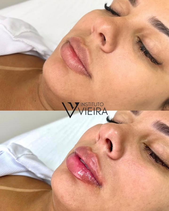 Antes e Depois Estética Facial